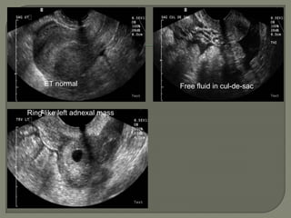 ACUTE ABDOMEN SONOGRAPHIC FINDINGS ppt | PPTX