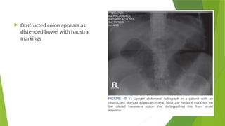 Haustral Activity Acute abdomen and It's Surgical Relevance ppt.pptx