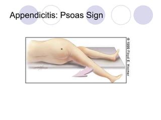 Appendicitis: Psoas Sign
 