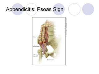 Appendicitis: Psoas Sign
 