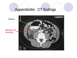 Appendicitis: CT findings
Abscess, fat
stranding
Cecum
 