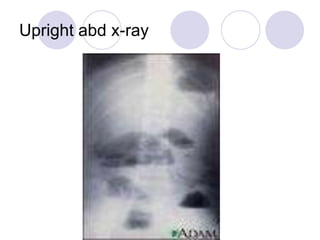 Upright abd x-ray
 