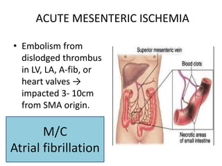 Acute abdominal pain | PPTX