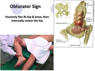 Testing Obturator Sign Acute abdominal pain | PPT