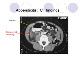 Appendicitis: CT findings
Abscess, fat
stranding
Cecum
 