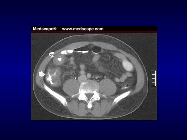 ACUTE ADOMEN AND APPENDICITIS for Surgery.ppt | Digestive Disorders ...