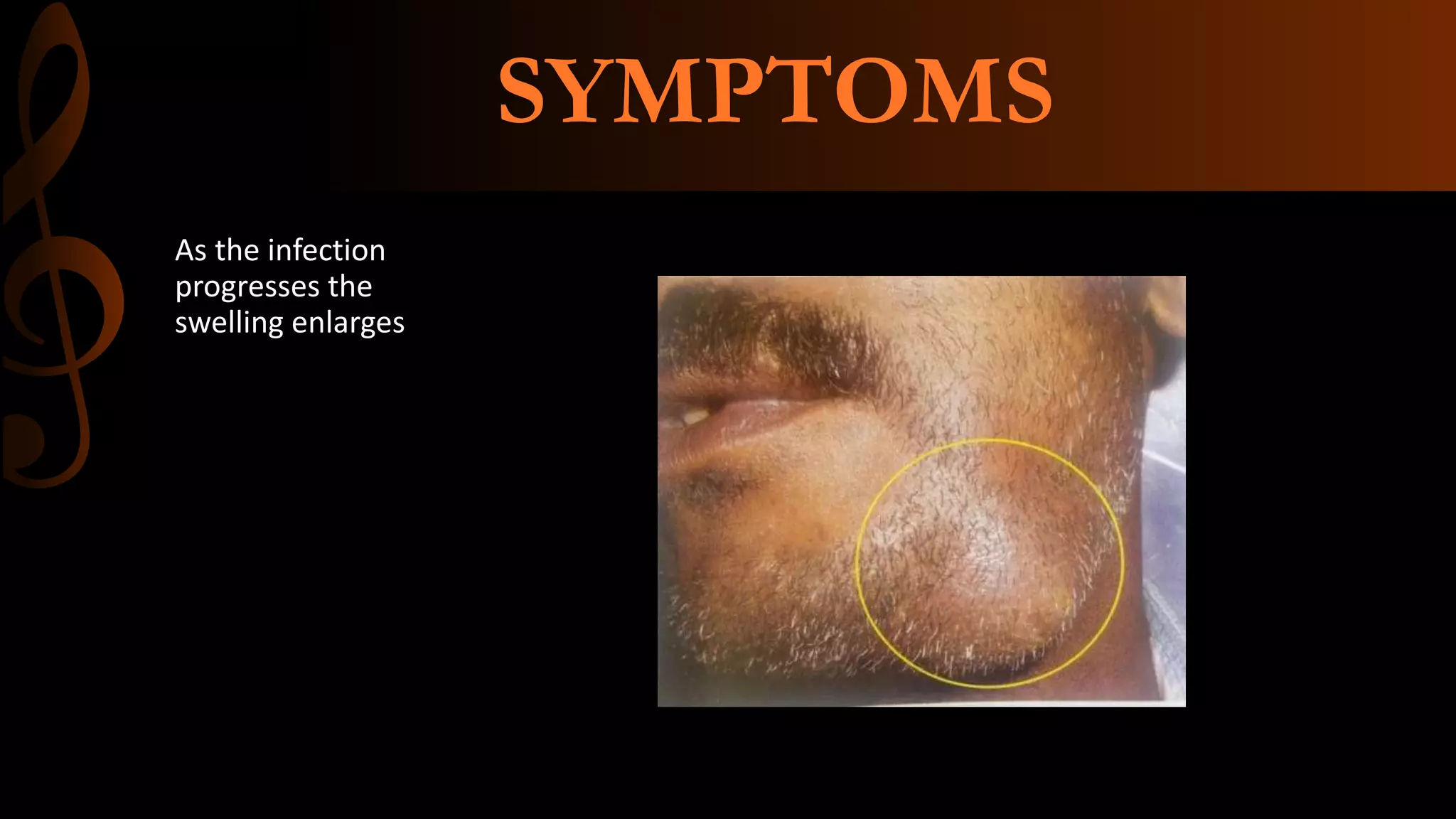 Acute alveolar abscess | PPTX