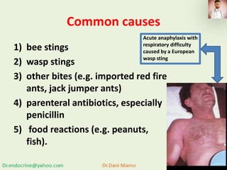 Common causes
1) bee stings
2) wasp stings
3) other bites (e.g. imported red fire
ants, jack jumper ants)
4) parenteral antibiotics, especially
penicillin
5) food reactions (e.g. peanuts,
fish).
Acute anaphylaxis with
respiratory difficulty
caused by a European
wasp sting
 