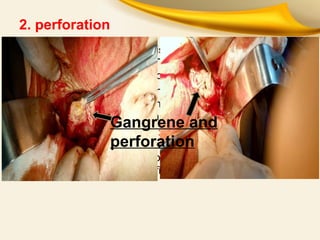 2. perforation
a. Pericholecystic abscess: is common, palpable mass,
toxication, fever, WBC . Treats by cholecystectomy in
poor condition subcutaneous cholecystostomy.
b. Free perforation: occurs in1-2% in early gangrene
before adhesion formation and in rupture of localized
abscess with sudden pain.
3. Cholecystoenteric fistula: with stomach, duodenum,
colon adherent and necrosis and then fistula formation,
gallstone ileus, malabsorption and steatorhea. In most
cases fistula has no significant symptoms and clinic.
Gangrene and
perforation
 