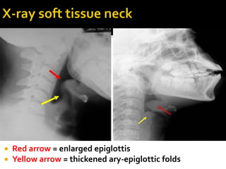 Stylalgia ACUTE AND CHRONIC CONDITION OF PHARYNX & LARYNX.ppt