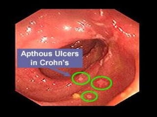 ACUTE AND CHRONIC DIARRHEOA IN ADULTS.ppt