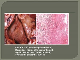 FIGURE 2-19 Fibrinous pericarditis. A,
Deposits of fibrin on the pericardium. B,
A pink meshwork of fibrin exudate (F)
overlies the pericardial surface
 
