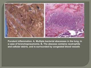 Purulent inflammation. A, Multiple bacterial abscesses in the lung, in
a case of bronchopneumonia. B, The abscess contains neutrophils
and cellular debris, and is surrounded by congested blood vessels
 