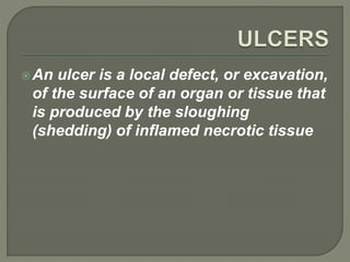 An ulcer is a local defect, or excavation,
of the surface of an organ or tissue that
is produced by the sloughing
(shedding) of inflamed necrotic tissue
 