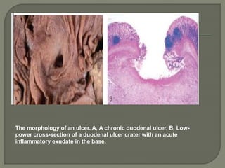 The morphology of an ulcer. A, A chronic duodenal ulcer. B, Low-
power cross-section of a duodenal ulcer crater with an acute
inflammatory exudate in the base.
 