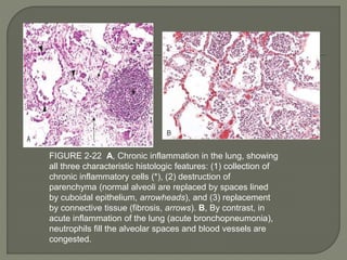 FIGURE 2-22 A, Chronic inflammation in the lung, showing
all three characteristic histologic features: (1) collection of
chronic inflammatory cells (*), (2) destruction of
parenchyma (normal alveoli are replaced by spaces lined
by cuboidal epithelium, arrowheads), and (3) replacement
by connective tissue (fibrosis, arrows). B, By contrast, in
acute inflammation of the lung (acute bronchopneumonia),
neutrophils fill the alveolar spaces and blood vessels are
congested.
 
