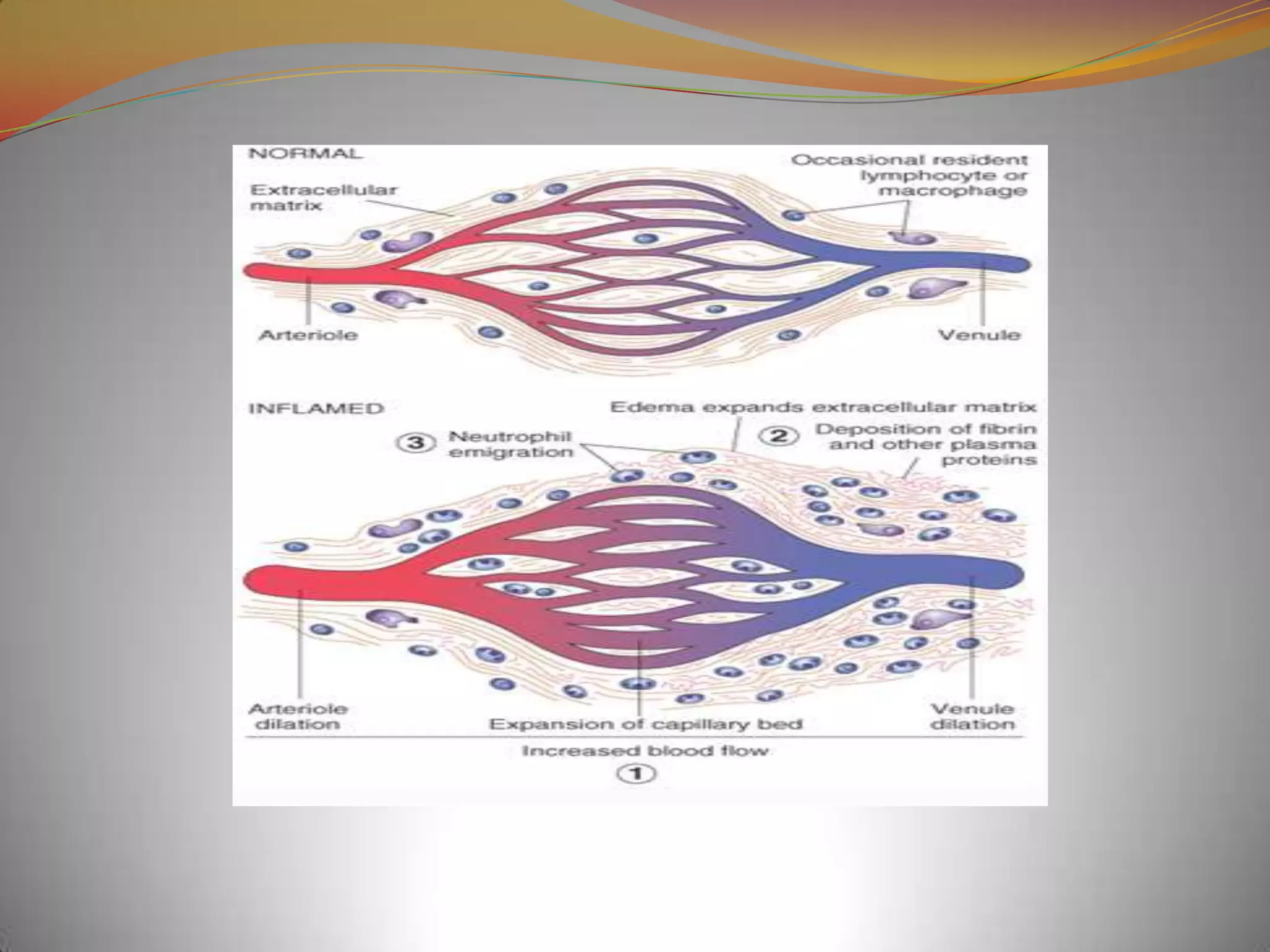 Acute and chronic inflammation 1 robbins | PPTX