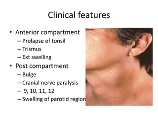 Clinical features
• Anterior compartment
– Prolapse of tonsil
– Trismus
– Ext swelling
• Post compartment
– Bulge
– Cranial nerve paralysis
– 9, 10, 11, 12
– Swelling of parotid region
 