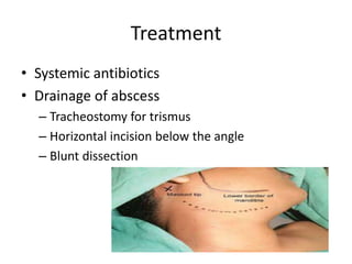Treatment
• Systemic antibiotics
• Drainage of abscess
– Tracheostomy for trismus
– Horizontal incision below the angle
– Blunt dissection
 