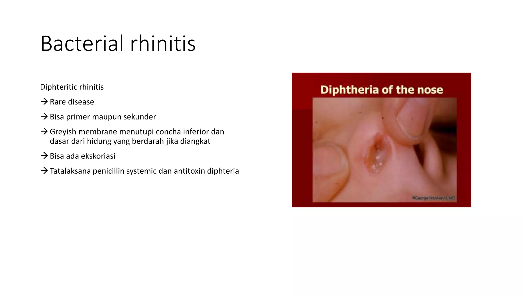 Concha Rhinitis Acute and chronic rhinitis.pptx