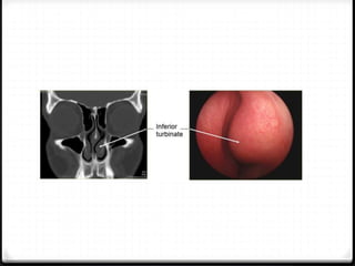 Chronic Rhinitis Imag acute and chronic rhinitis - powerpoint | PPT