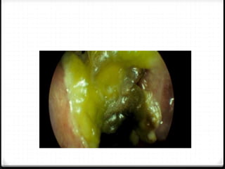 acute and chronic rhinitis - powerpoint | PPT