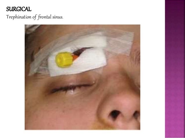Sinus infection in eye