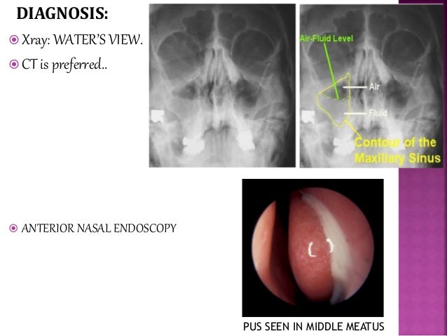 Acute And Chronic Sinusitis