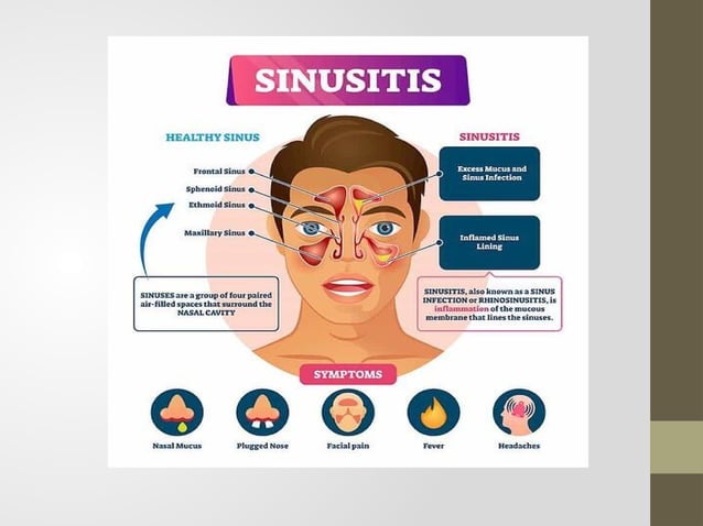 ACUTE AND CHRONIC SINUSITIS.pptxmmmmmmmm | PPT