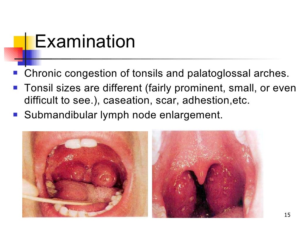 Acute and chronic tonsilitis