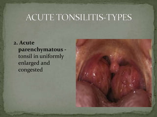 2. Acute
parenchymatous -
tonsil in uniformly
enlarged and
congested
 