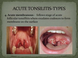 4. Acute membranous - follows stage of acute
follicular tonsillitis where exudates coalesces to form
membrane on the surface
 