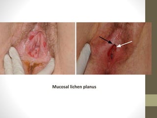 Mucosal lichen planus
 
