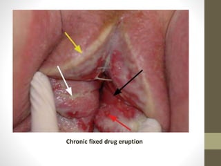 Chronic fixed drug eruption
 