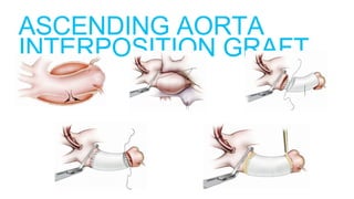 ASCENDING AORTA
INTERPOSITION GRAFT
 