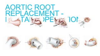 AORTIC ROOT
REPLACEMENT -
BENTALL OPERATION
 