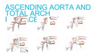 ASCENDING AORTA AND
TOTAL ARCH
REPLACEMENT
 