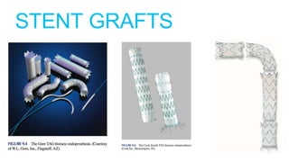 STENT GRAFTS
 