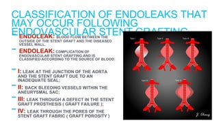 - ENDOLEAK: BLOOD FLOW BETWEEN THE
OUTSIDE OF THE STENT GRAFT AND THE DISEASED
VESSEL WALL.
- ENDOLEAK: COMPLICATION OF
ENDOVASCULAR STENT GRAFTING AND IS
CLASSIFIED ACCORDING TO THE SOURCE OF BLOOD:
-I: LEAK AT THE JUNCTION OF THE AORTA
AND THE STENT GRAFT DUE TO AN
INADEQUATE SEAL;
-II: BACK BLEEDING VESSELS WITHIN THE
ANEURYSMAL SAC;
-III: LEAK THROUGH A DEFECT IN THE STENT
GRAFT PROSTHESIS ( GRAFT FAILURE );
-IV: LEAK THROUGH THE PORES OF THE
STENT GRAFT FABRIC ( GRAFT POROSITY )
CLASSIFICATION OF ENDOLEAKS THAT
MAY OCCUR FOLLOWING
ENDOVASCULAR STENT GRAFTING
 