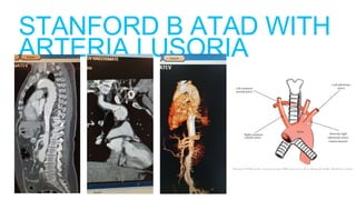 STANFORD B ATAD WITH
ARTERIA LUSORIA
 