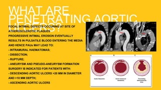 WHAT ARE
PENETRATING AORTIC
ULCERS?FOCAL INTIMAL DEFECTS OCCURING AT SITE OF
ATHEROSCLEROTIC PLAQUES
PROGRESSIVE INTIMAL EROSION EVENTUALLY
RESULTS IN PULSATILE BLOOD ENTERING THE MEDIA
AND HENCE PAUs MAY LEAD TO:
- INTRAMURAL HAEMATOMAS;
- DISSECTION;
- RUPTURE;
- ANEURYSM AND PSEUDO-ANEURYSM FORMATION
SURGERY IS INDICATED FOR PATIENTS WITH:
- DESCENDING AORTIC ULCERS >20 MM IN DIAMETER
AND >10 MM DEPTH;
- ASCENDING AORTIC ULCERS
 