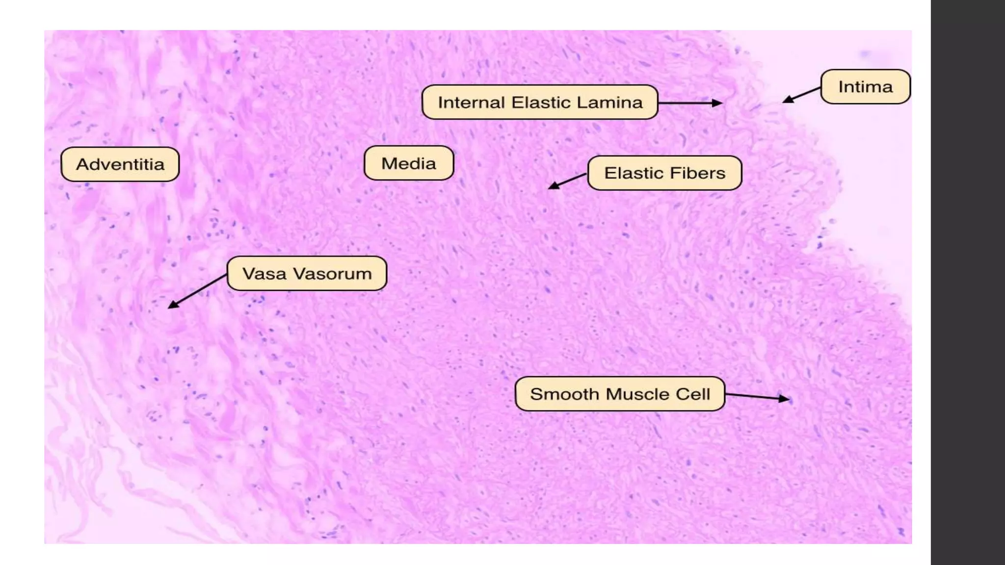 Acute aortic syndromes | PPTX