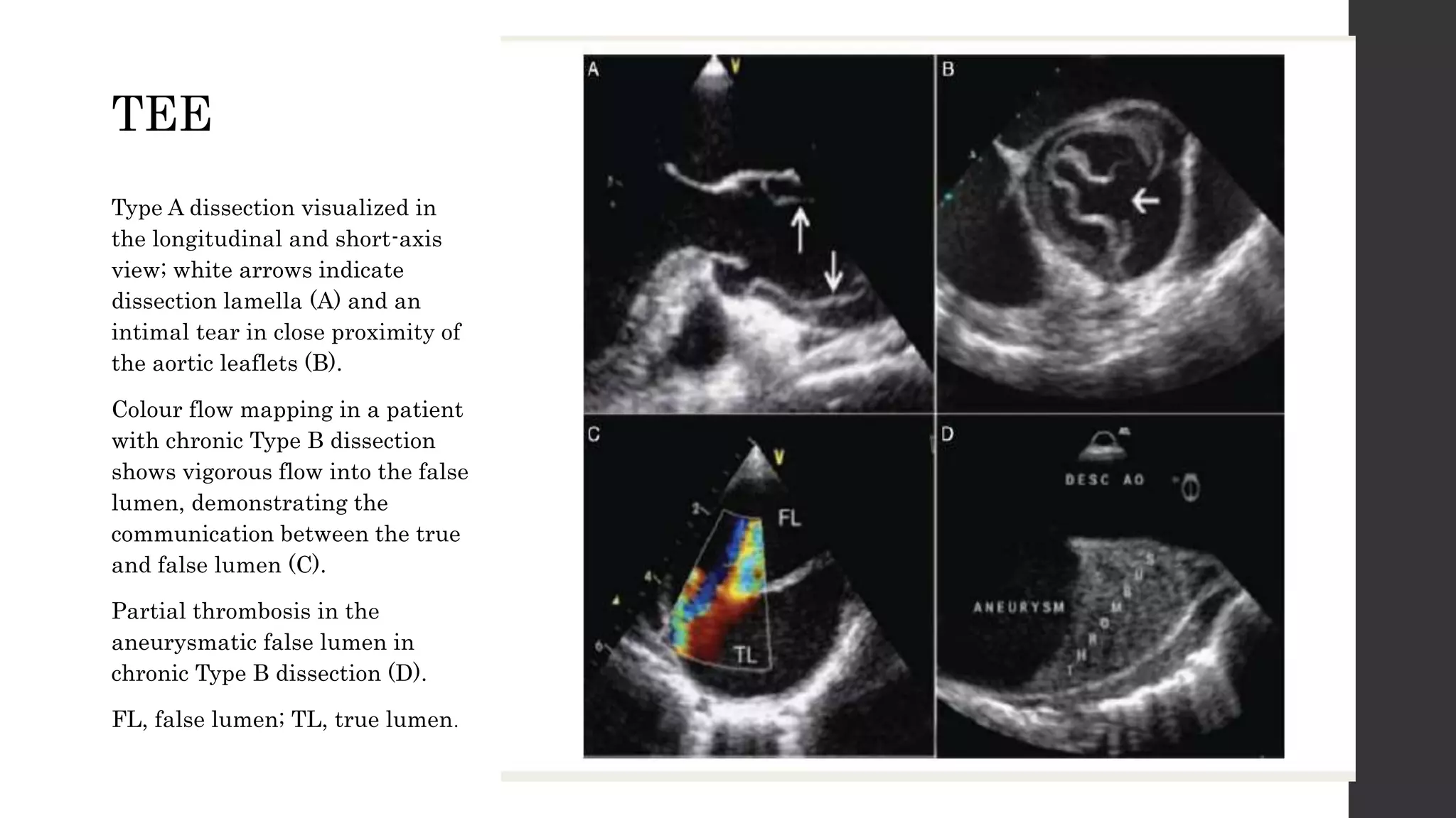Acute aortic syndromes | PPTX