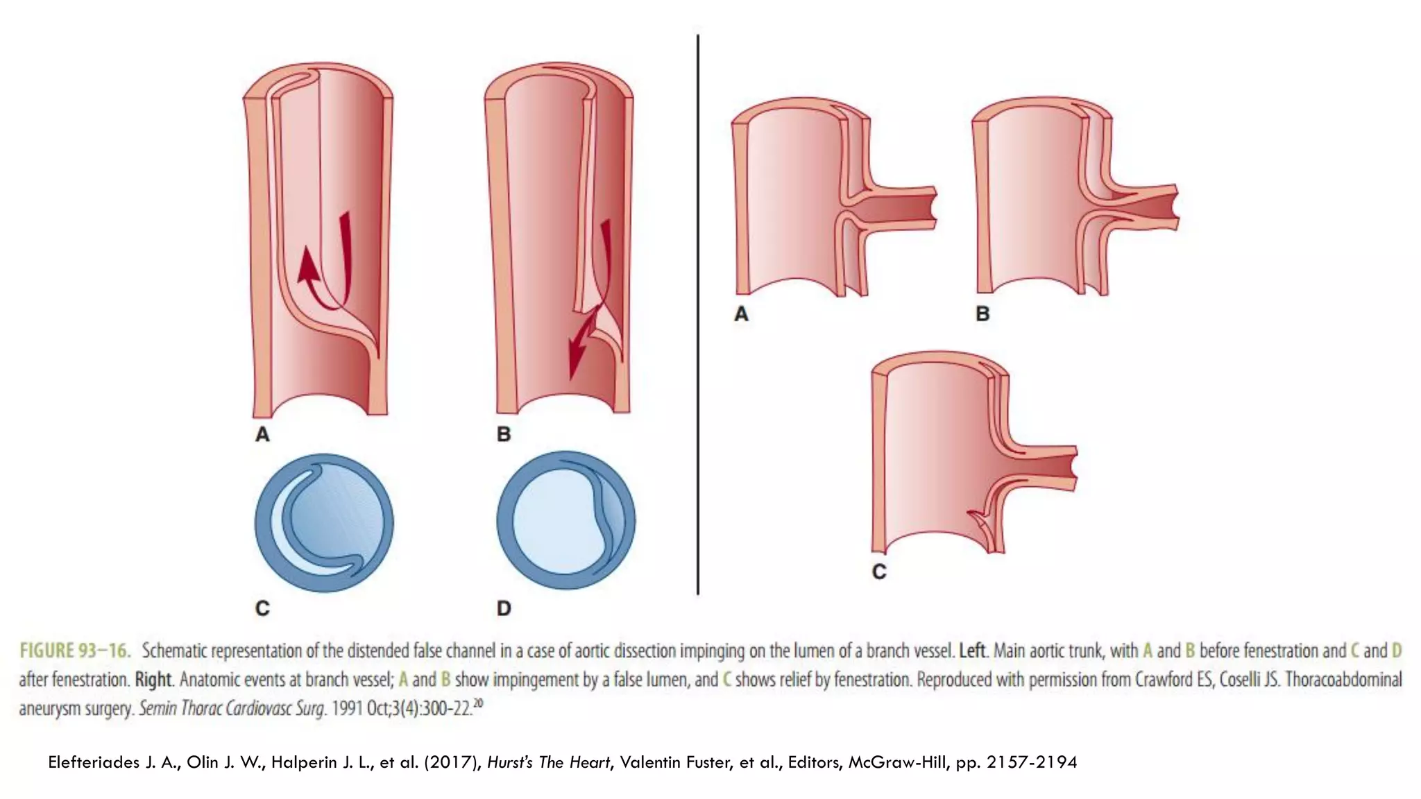 Elefteriades J. A., Olin J. W., Halperin J. L., et al. (2017), Hurst’s The Heart, Valentin Fuster, et al., Editors, McGraw-Hill, pp. 2157-2194
 