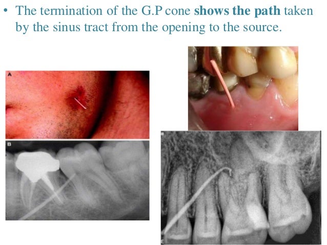 Acute apical abscess dr anirudh singh chauhan