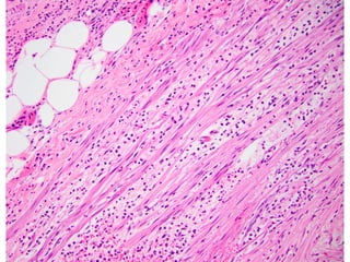 Comprehensive Overview of Acute Appendicitis: Pathology, Clinical ...