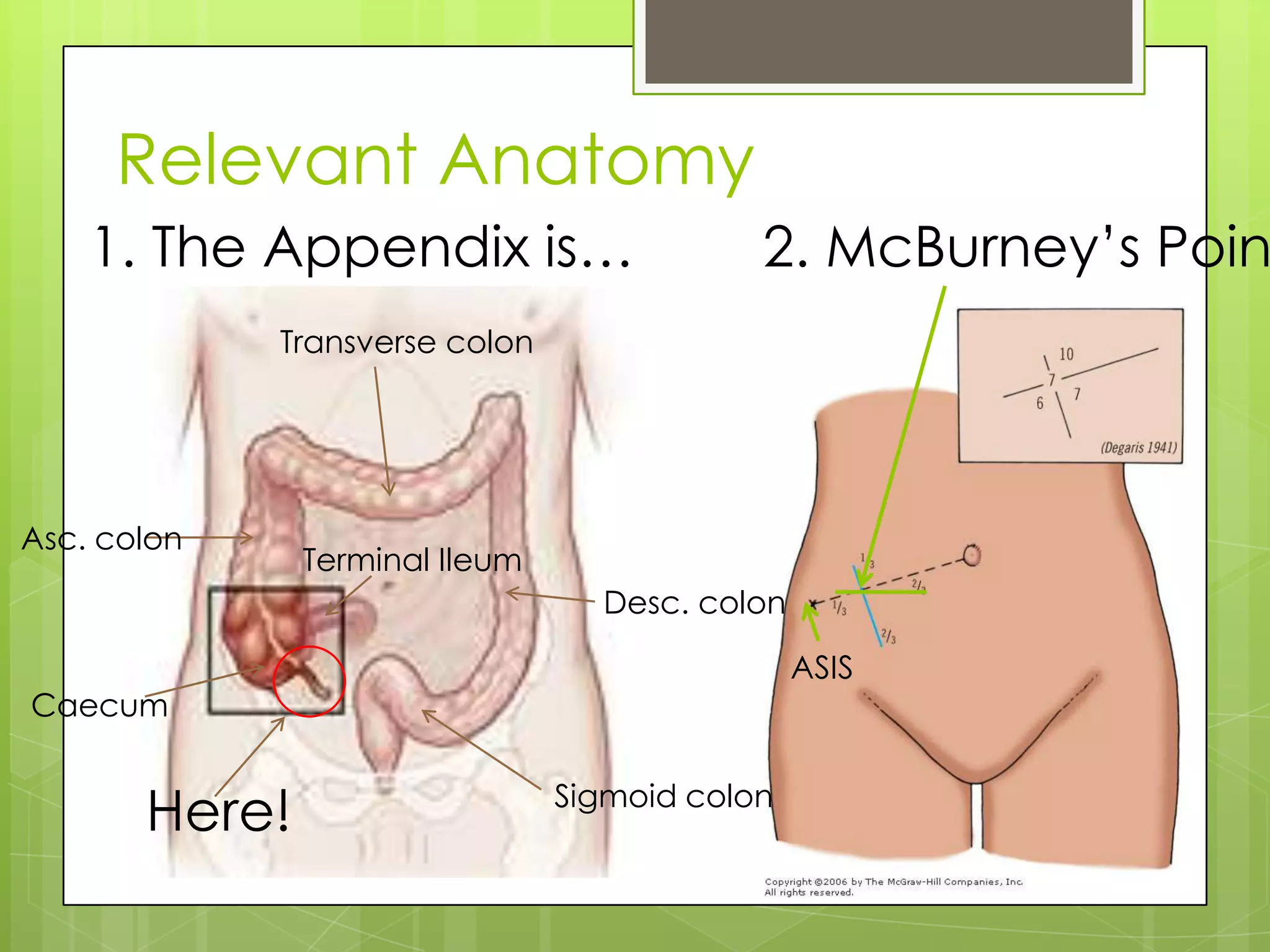 Acute appendicitis | PPTX