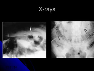 Acute Appendicitis | PPT