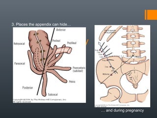 Acute appendicitis | PPT