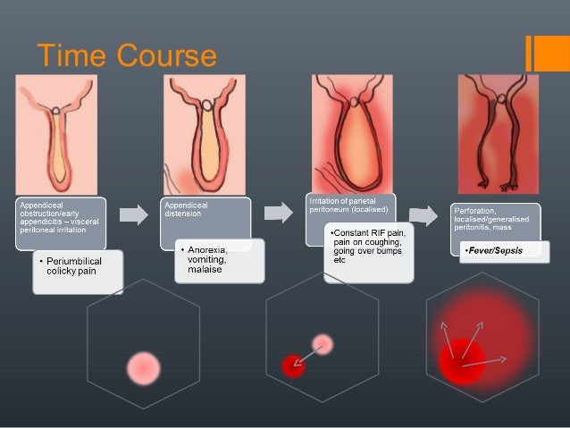 acute appendicitis
